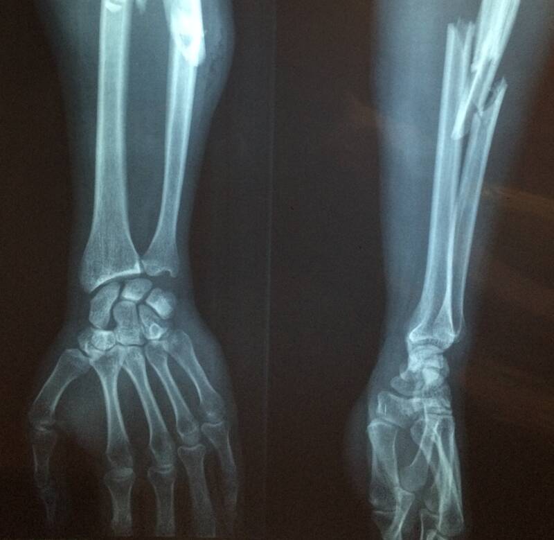 x ray of hand and arm with a fractured bone